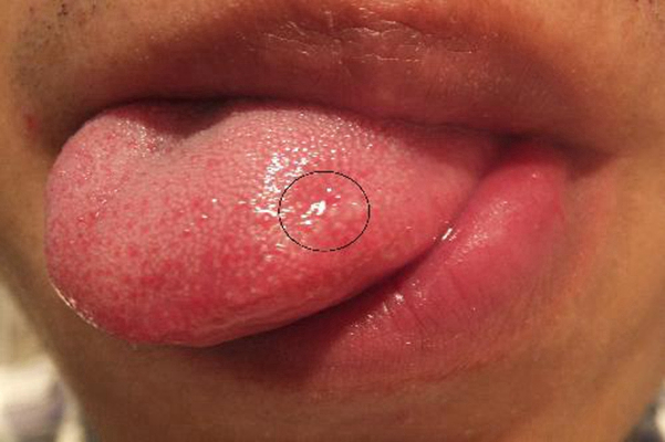 舌根癌有哪些症状