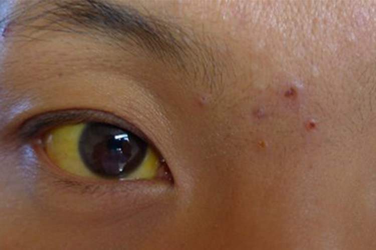 大人黄疸的症状有哪些