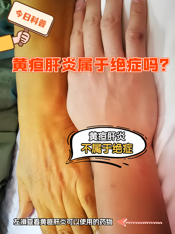 大人黄疸的症状有哪些