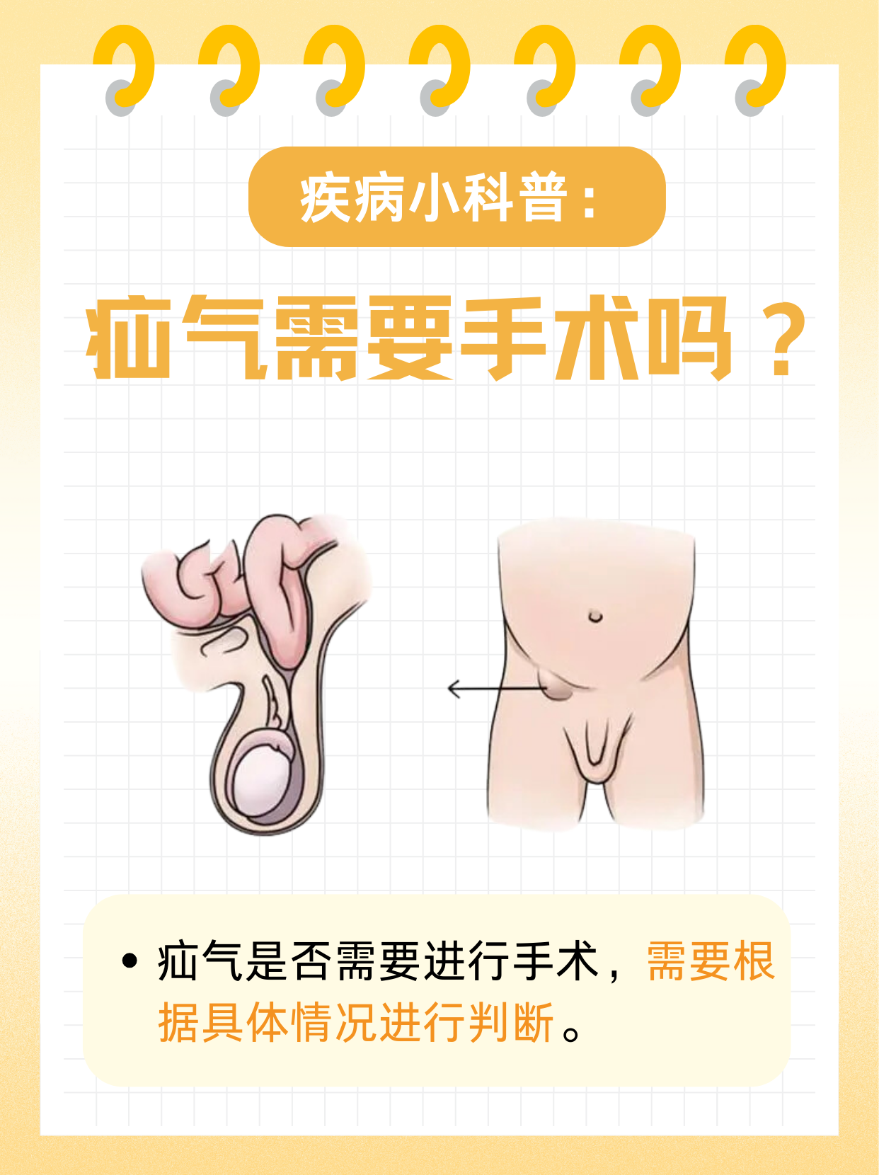 腹股沟斜疝与直疝区别