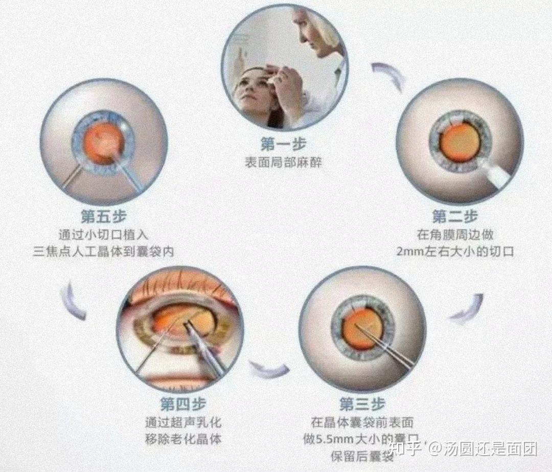 做完白内障手术吃什么好