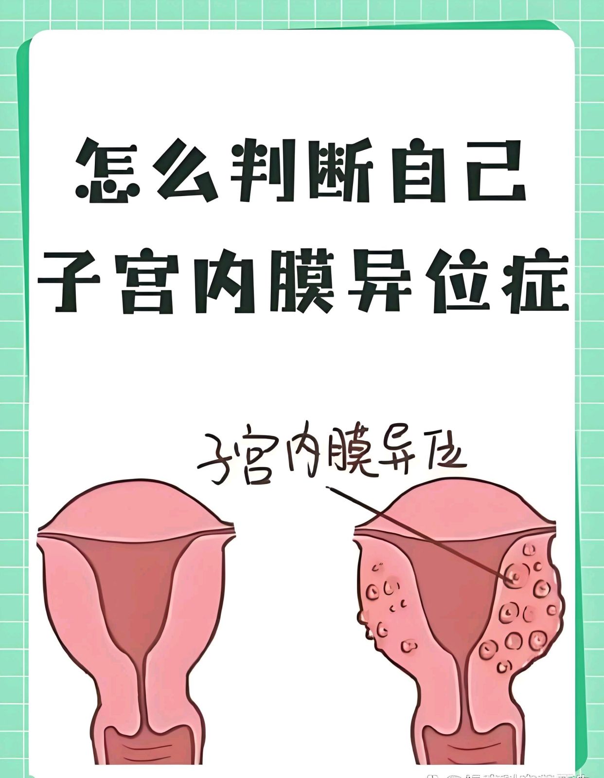 子宫内膜异位症什么症状