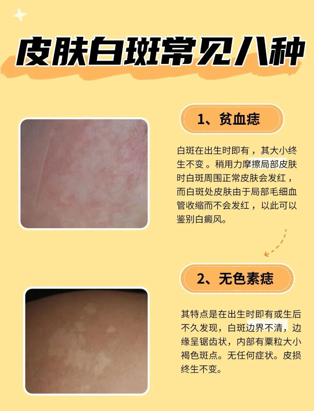 白色胎记和白斑的区别是什么?