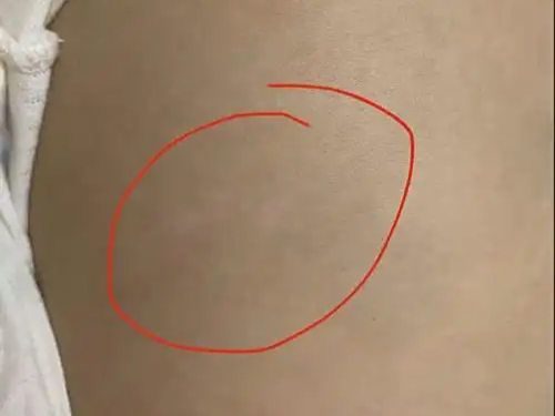 白色胎记和白斑的区别是什么?