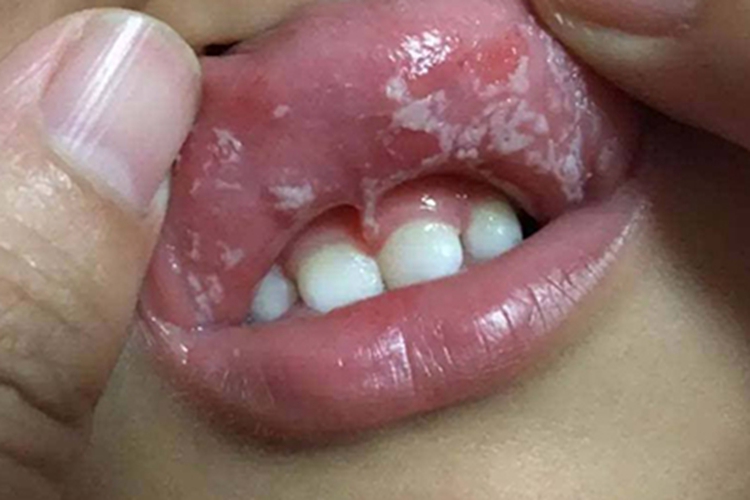 嘴唇白点颗粒是什么病