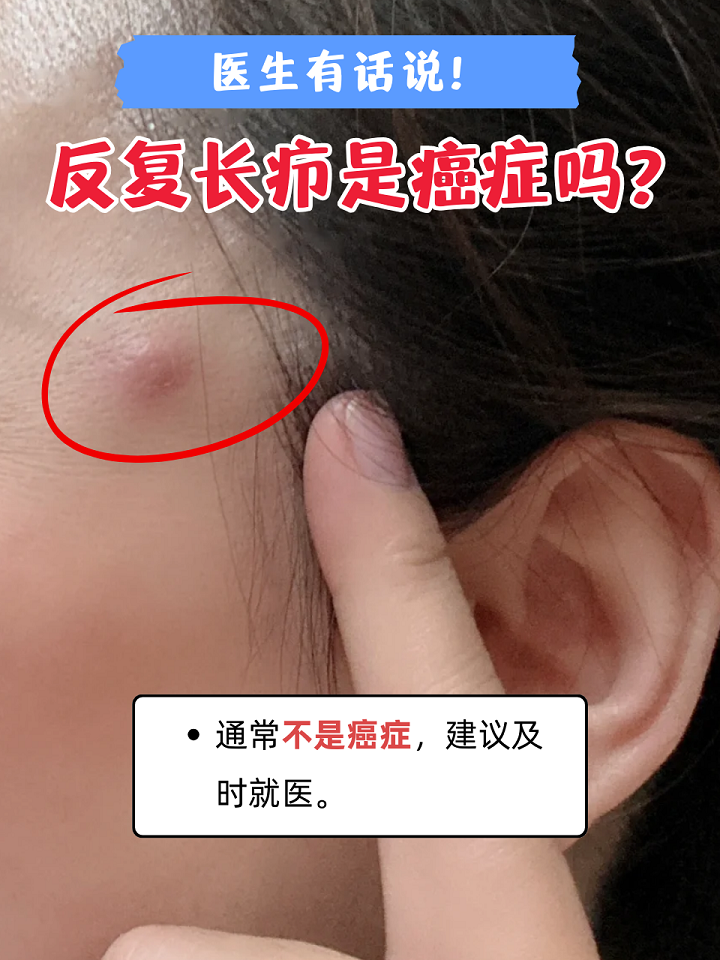 皮脂腺囊肿会癌变吗?