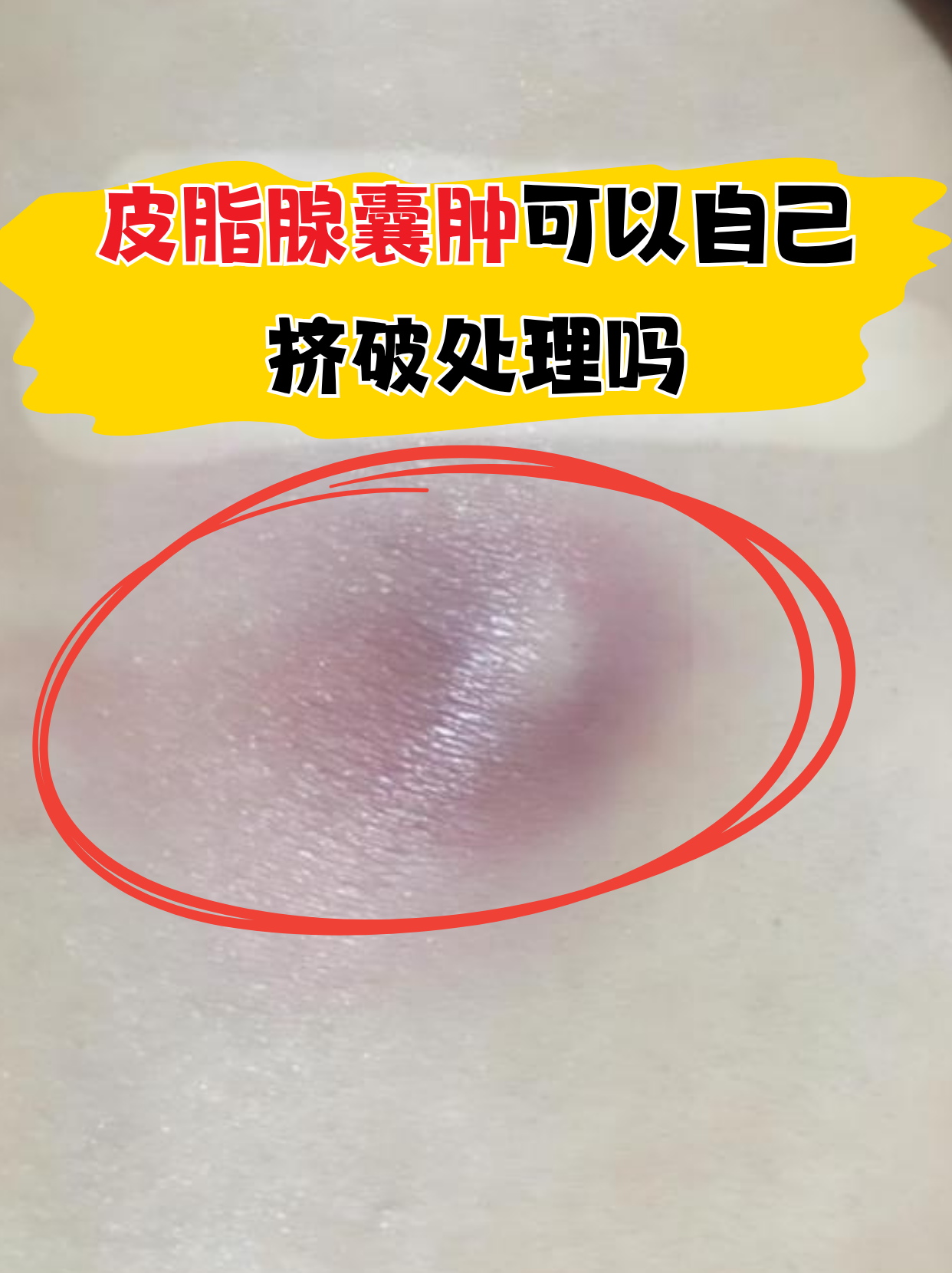 皮脂腺囊肿会癌变吗?