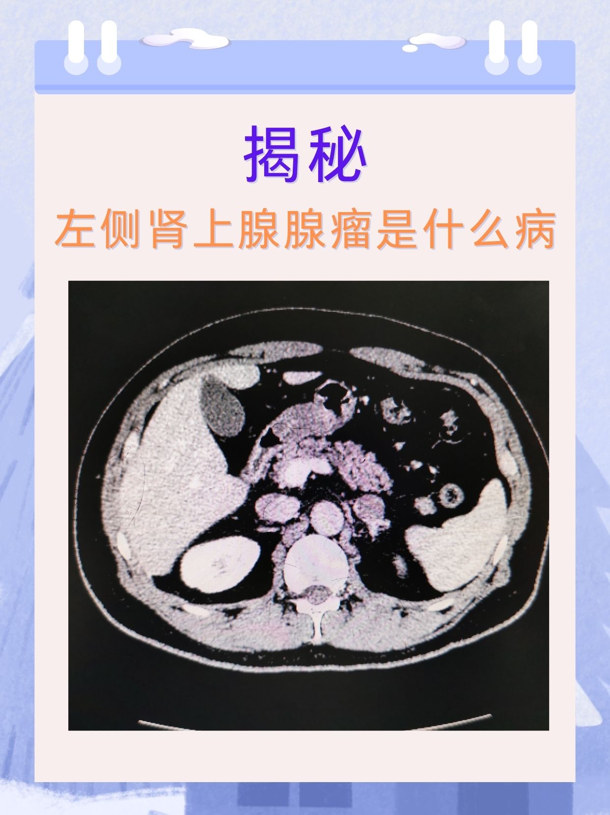 肾上腺危象是怎样的