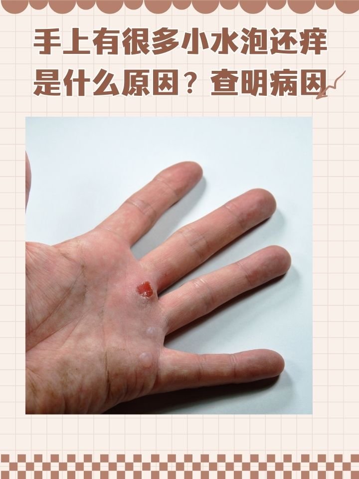 孩子手上起小水泡怎么回事