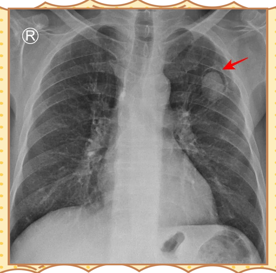 拍胸片能查出什么?