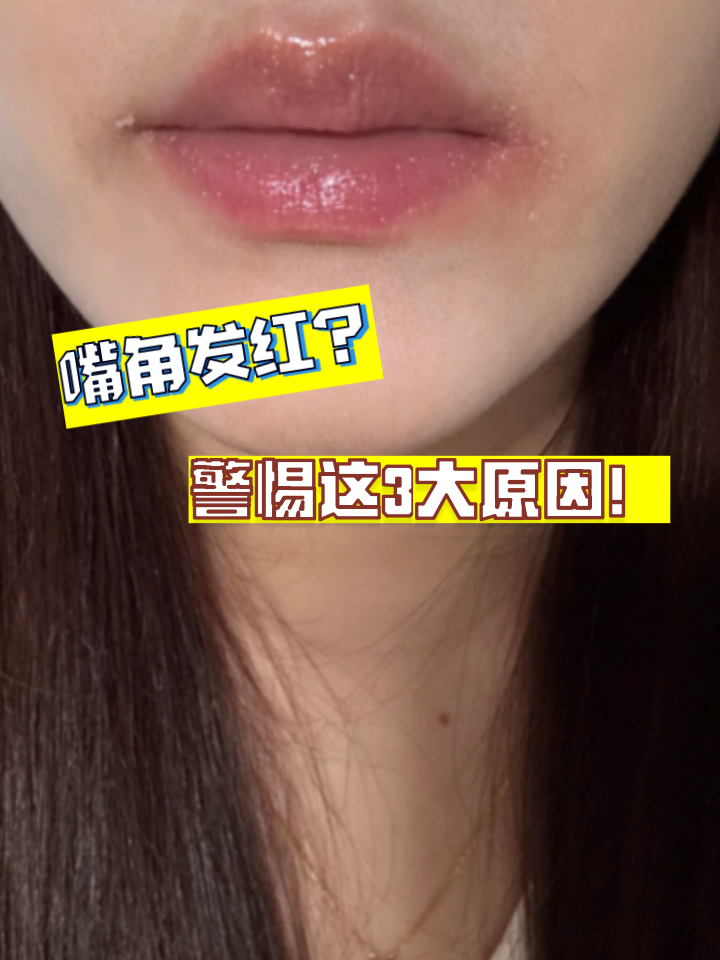 口角炎的发病原因有哪些