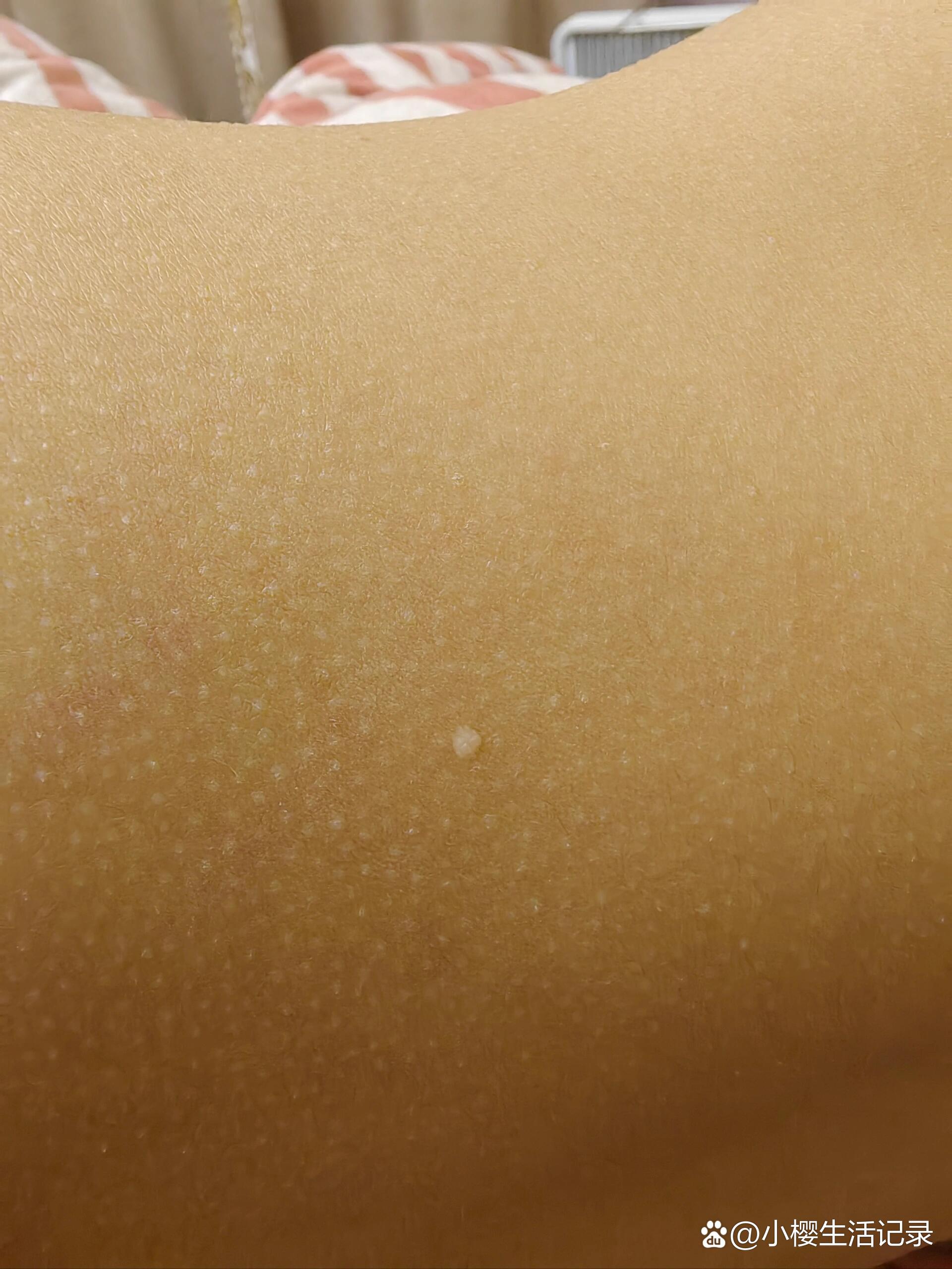 为什么全身长了很多白色的小疙瘩?