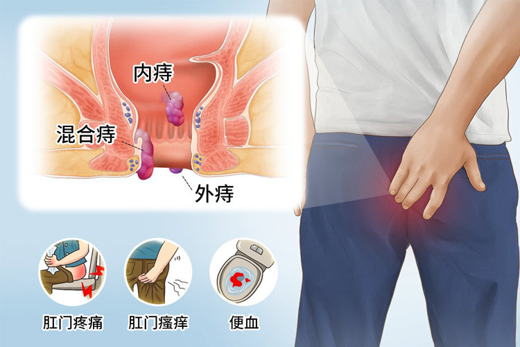 肛门周围癌在临床上有什么表现?
