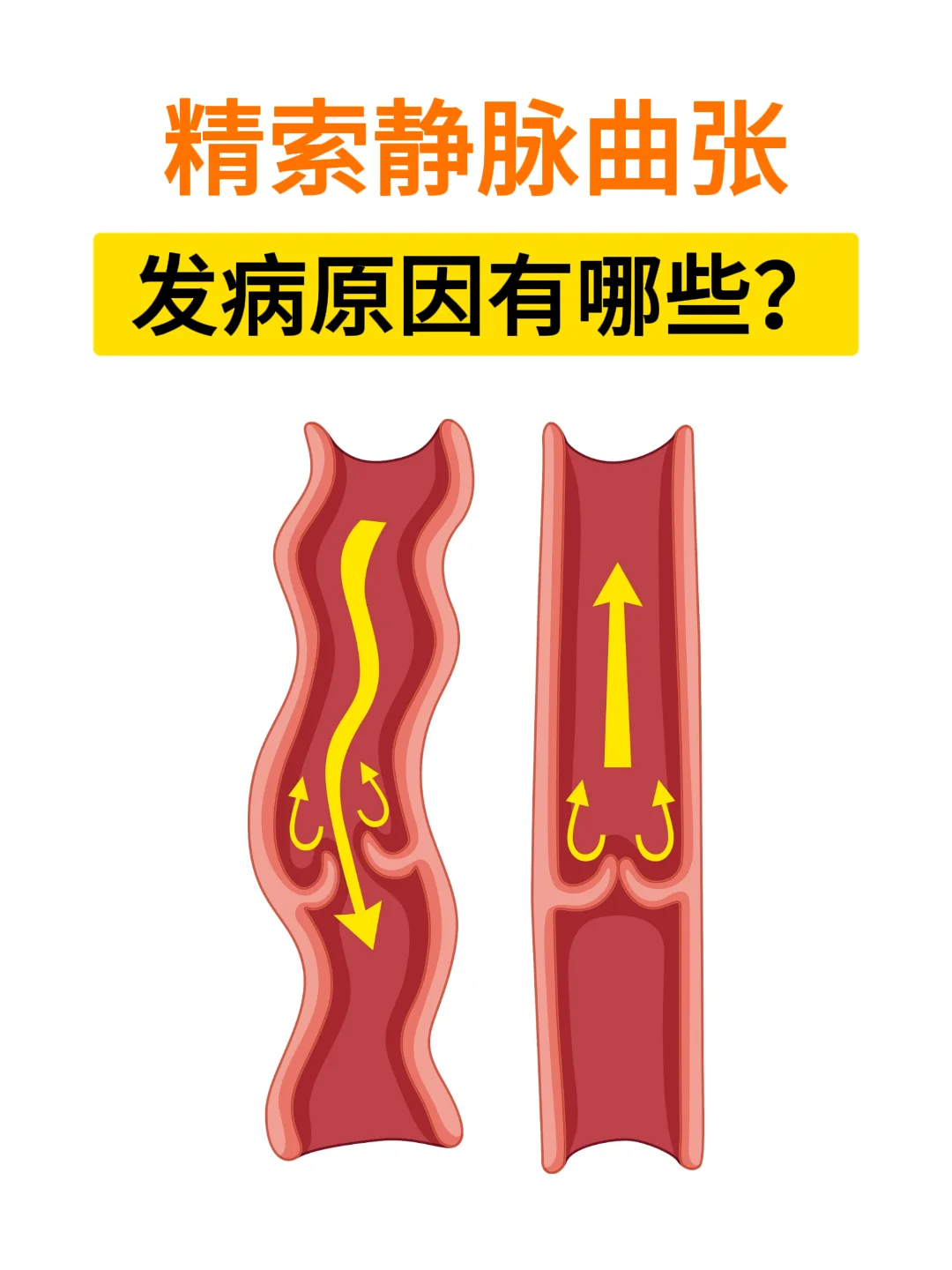 精索静脉曲张是怎么得的