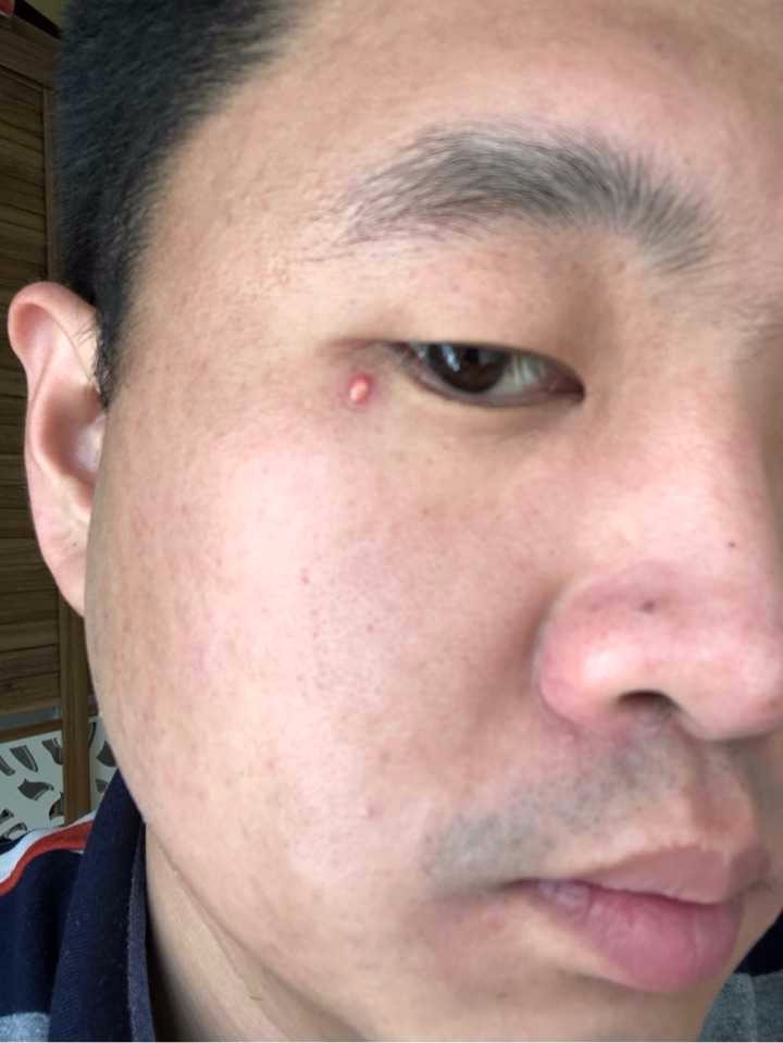 眼皮下有个小疙瘩