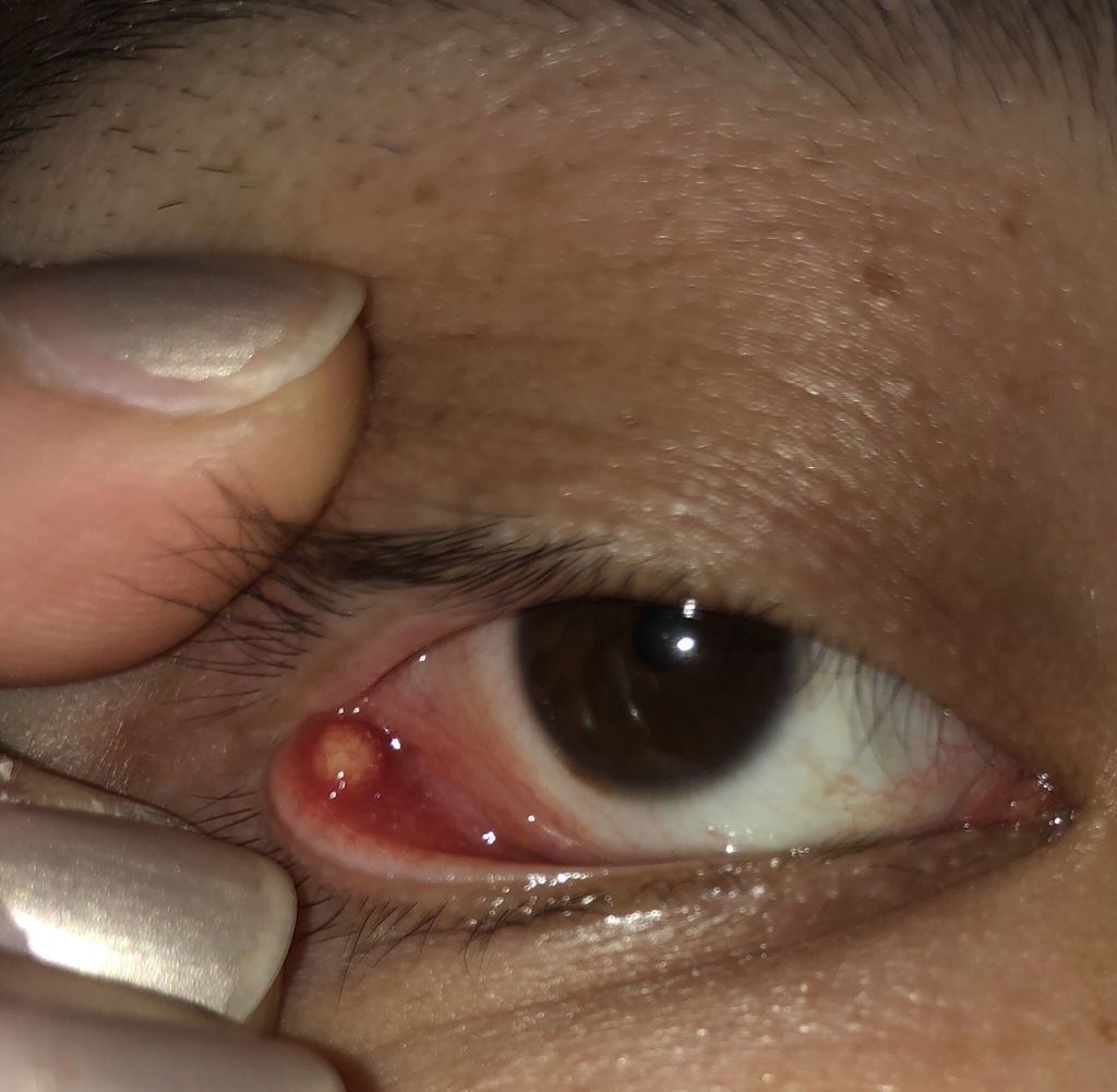 眼皮下有个小疙瘩