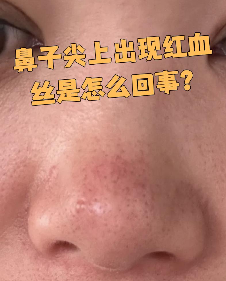 鼻子尖发红是什么原因
