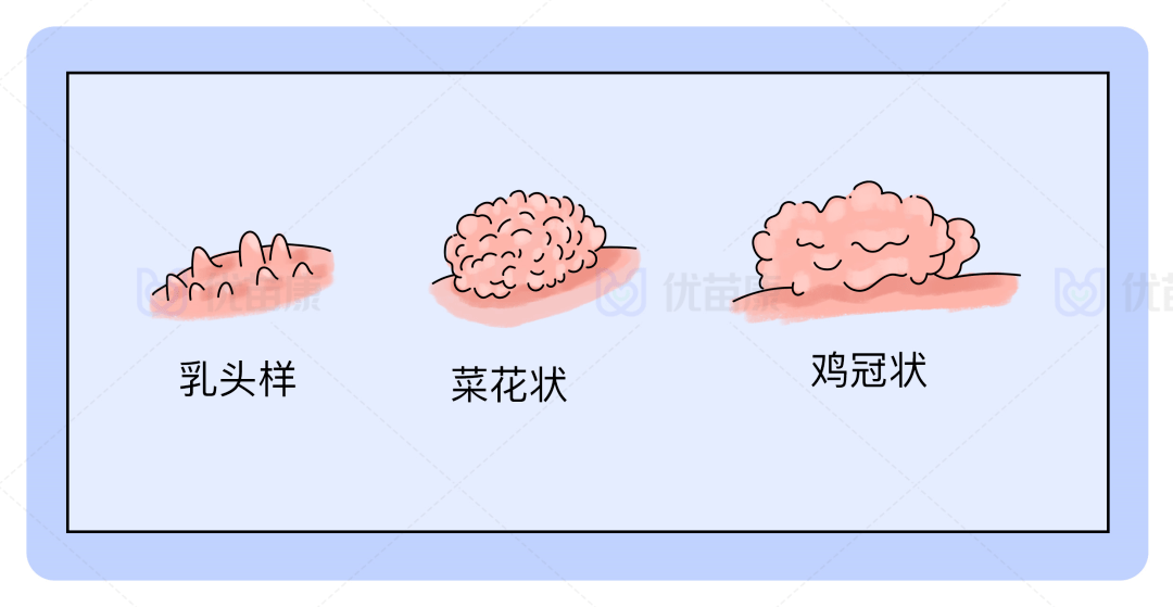 就是阴道口边长了肉芽一样的东西