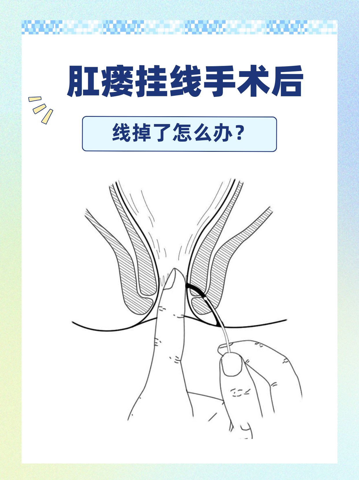 引起肛瘘的原因有哪些