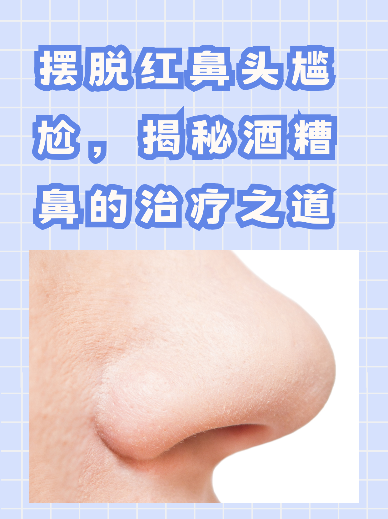 酒糟鼻形成的原因