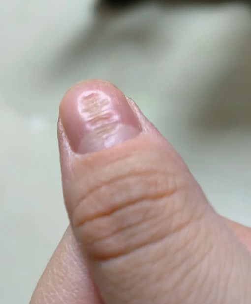指甲凹陷是什么原因
