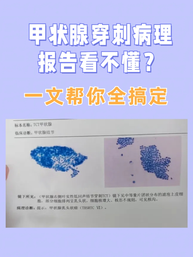 甲状腺穿刺活检的危害有哪些