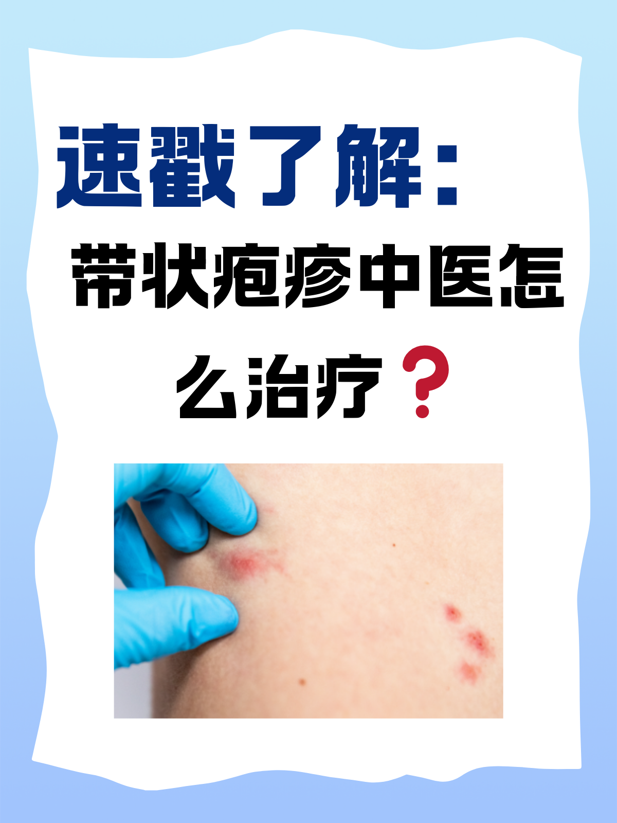 带状孢疹最有效偏方