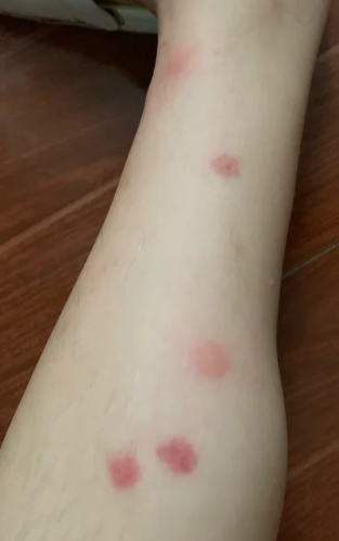 腿上突然长了很多小红点