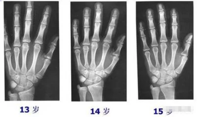 什么样的叫骨骺线闭合