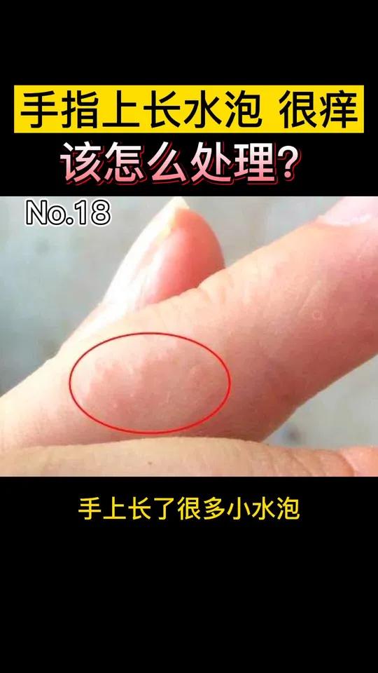 手指起水泡