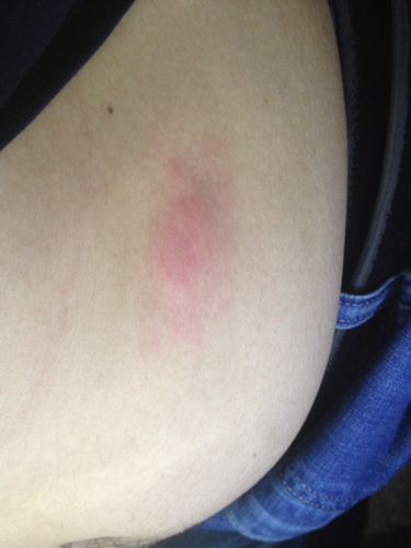 身上起大疙瘩,很痒,有点硬