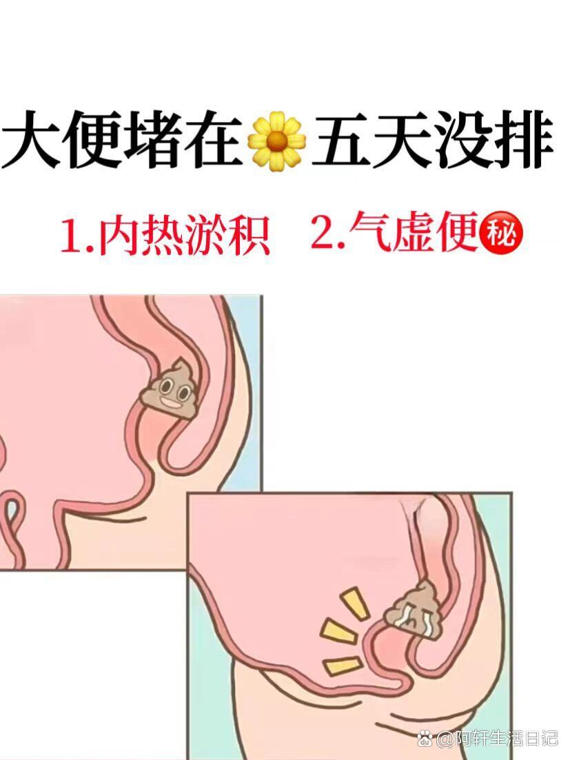 便秘拉不出来怎么办