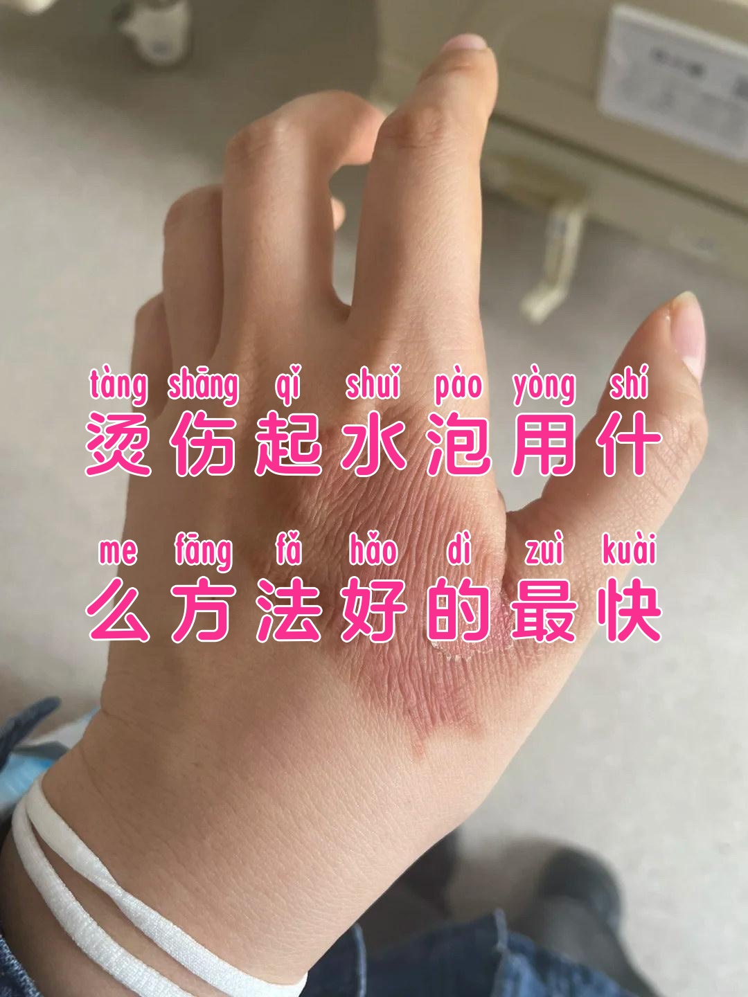 烫伤的水泡破了,咋办?