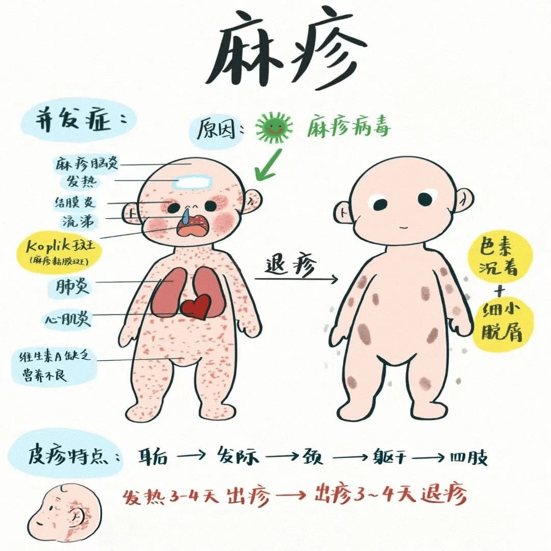 麻疹症状及治疗
