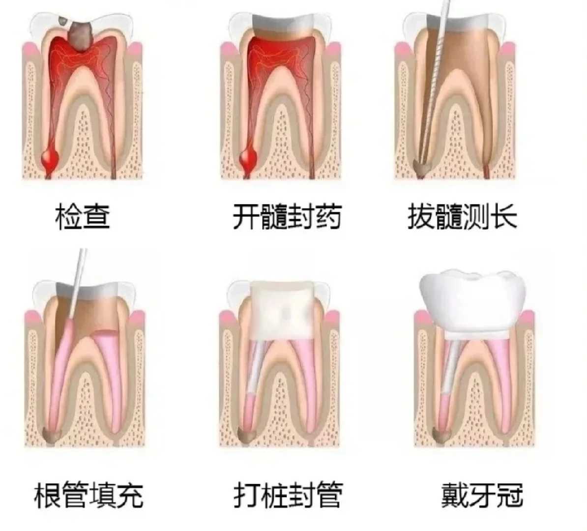 杀牙神经的步骤