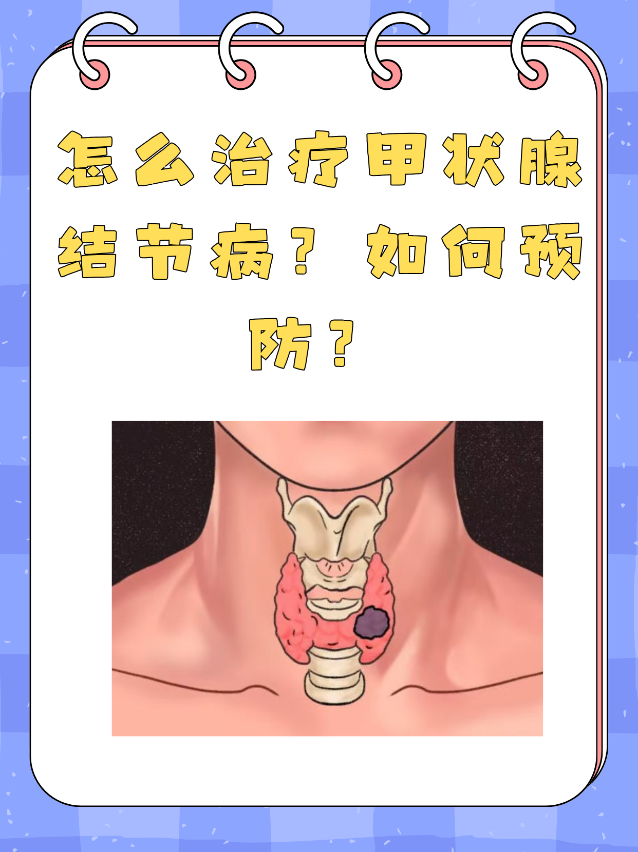 甲状腺结节一定要手术吗?