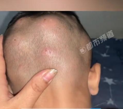 脸上莫名长包,像蚊子包