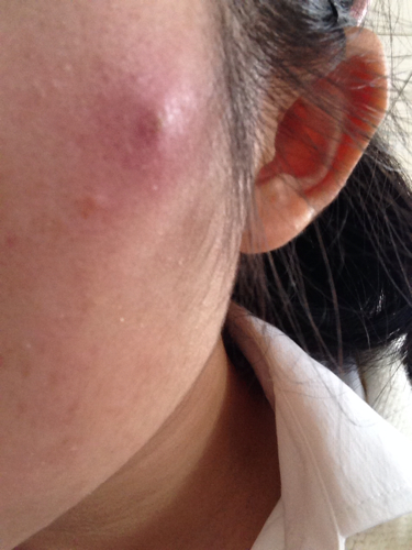 脸上莫名长包,像蚊子包