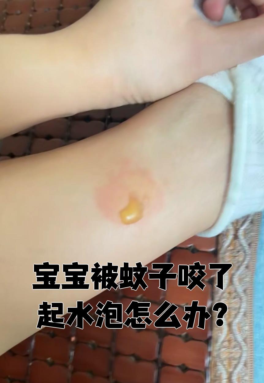 被虫子咬了起水泡怎么办?