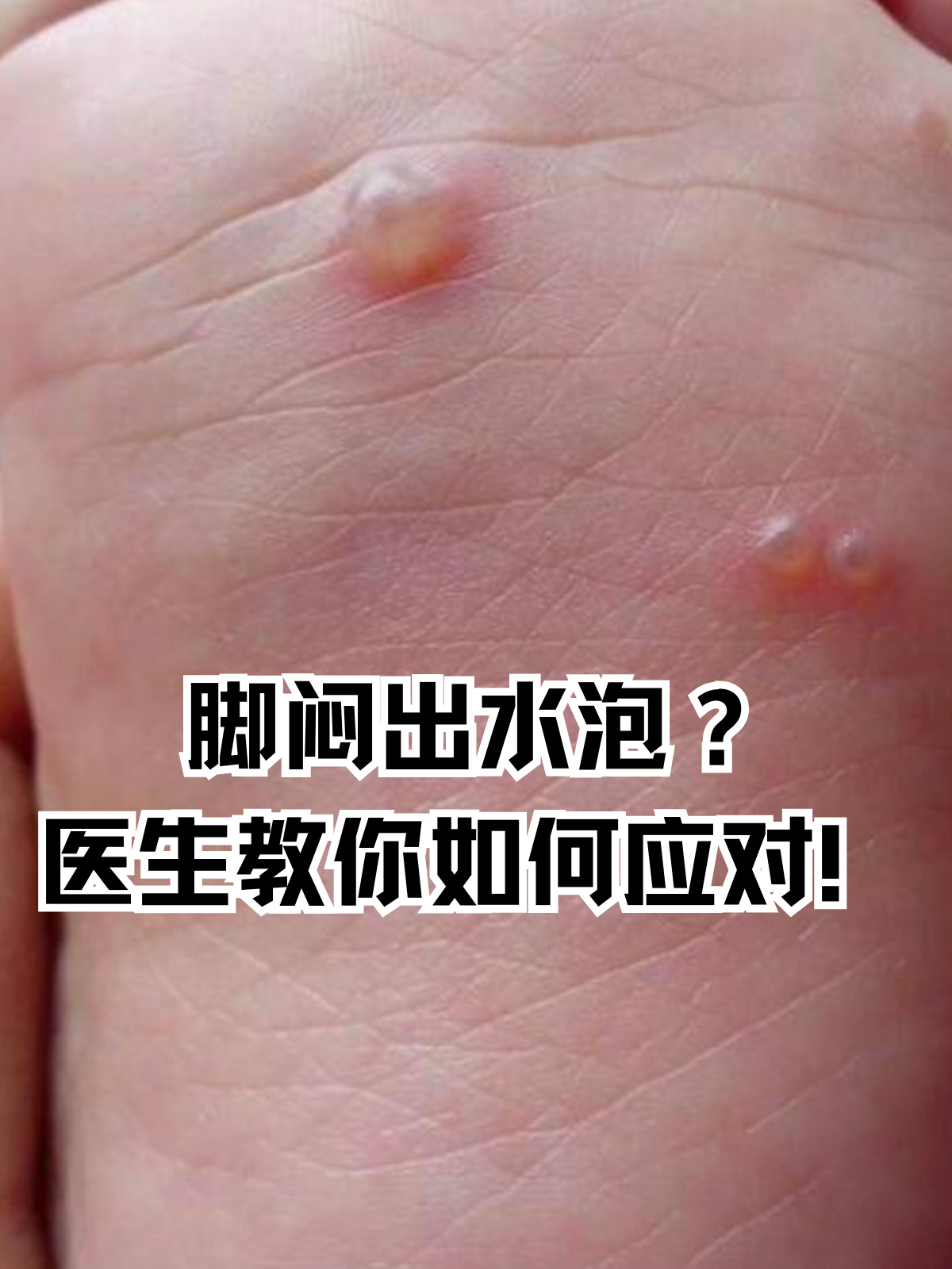 被虫子咬了起水泡怎么办?
