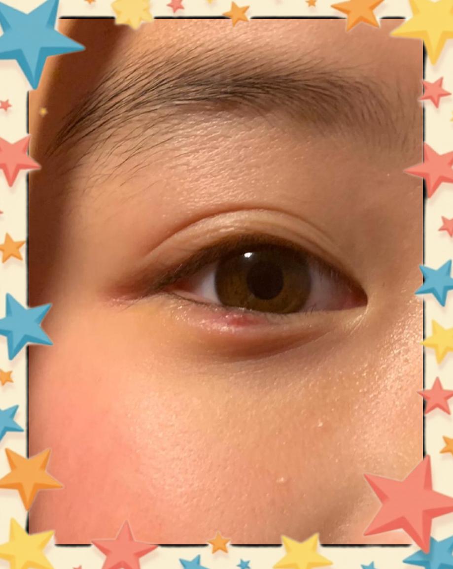 麦粒肿手术留疤吗