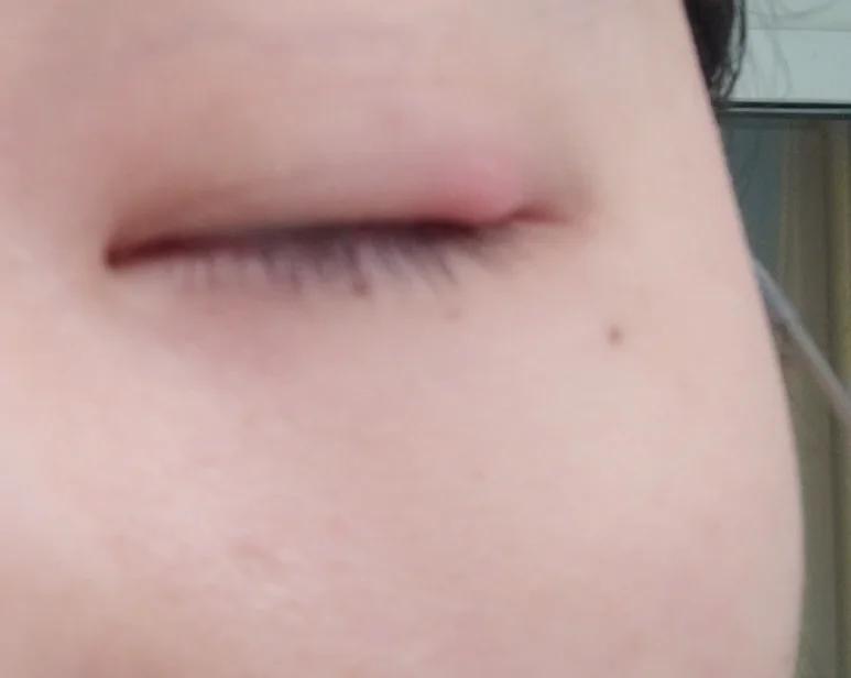 麦粒肿手术留疤吗