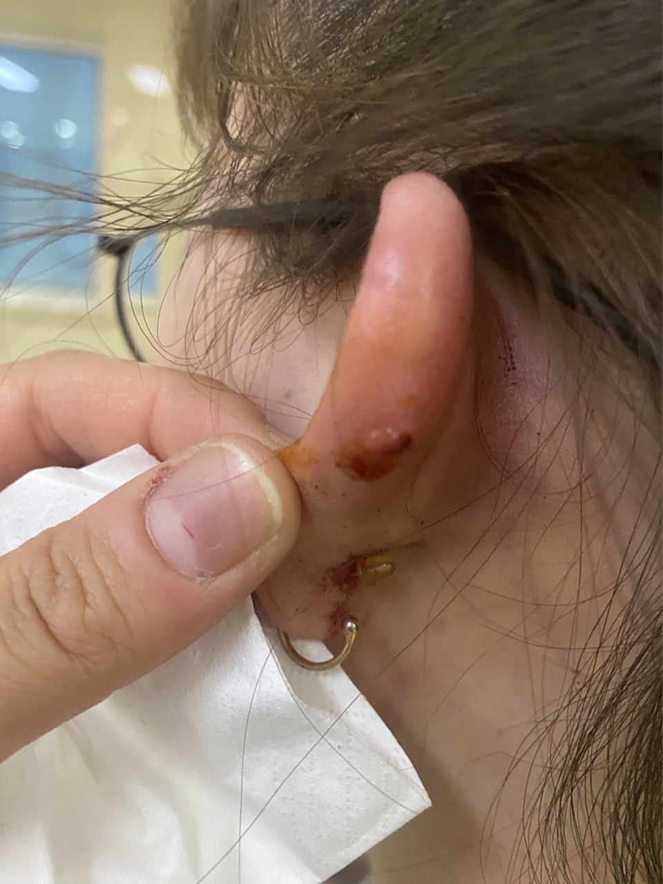 耳洞发炎流血怎么办