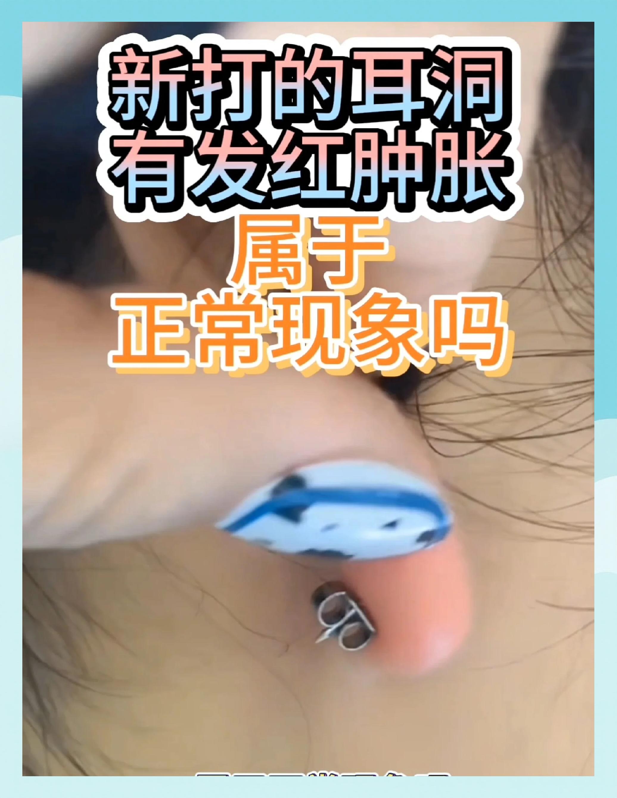 耳洞发炎流血怎么办