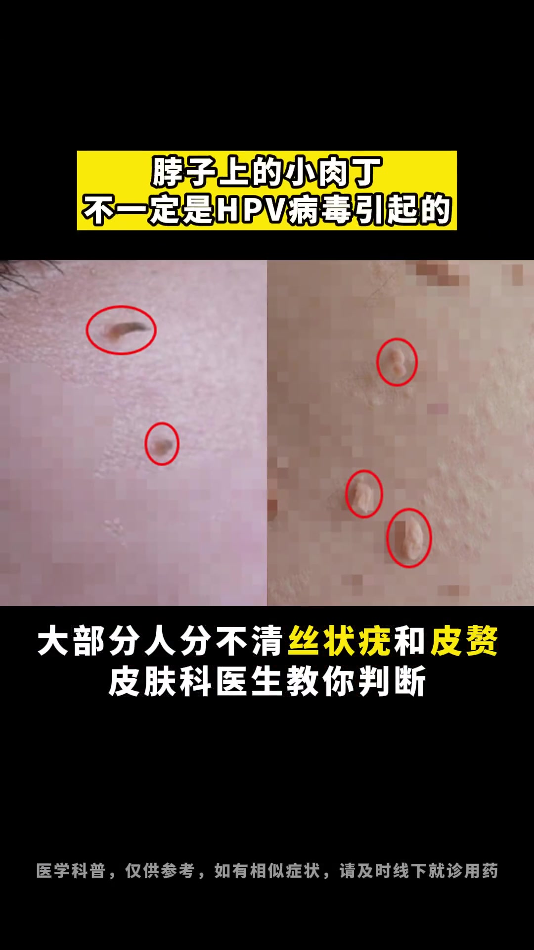 皮赘与丝状疣的区别