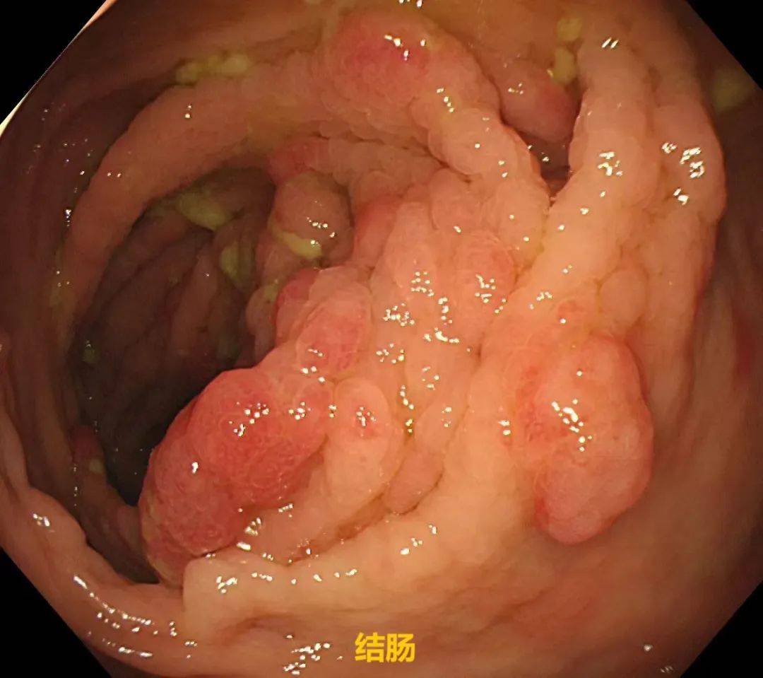 胃多发息肉会很严重吗