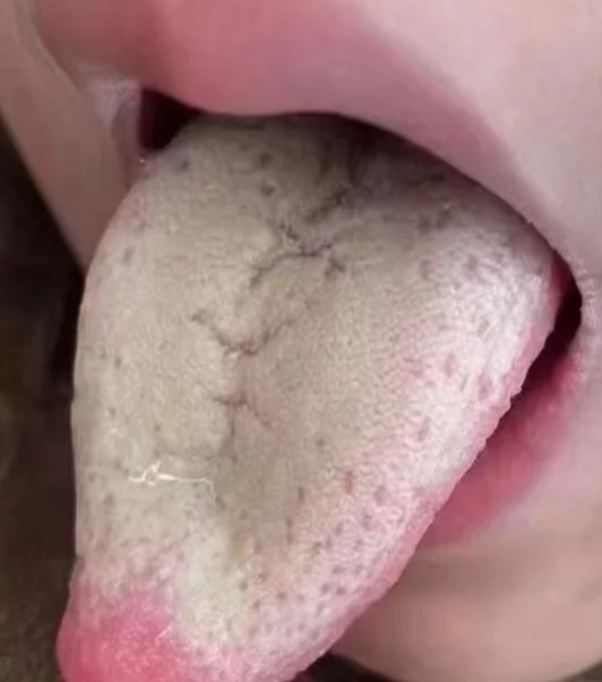 舌苔厚白是什么情况?