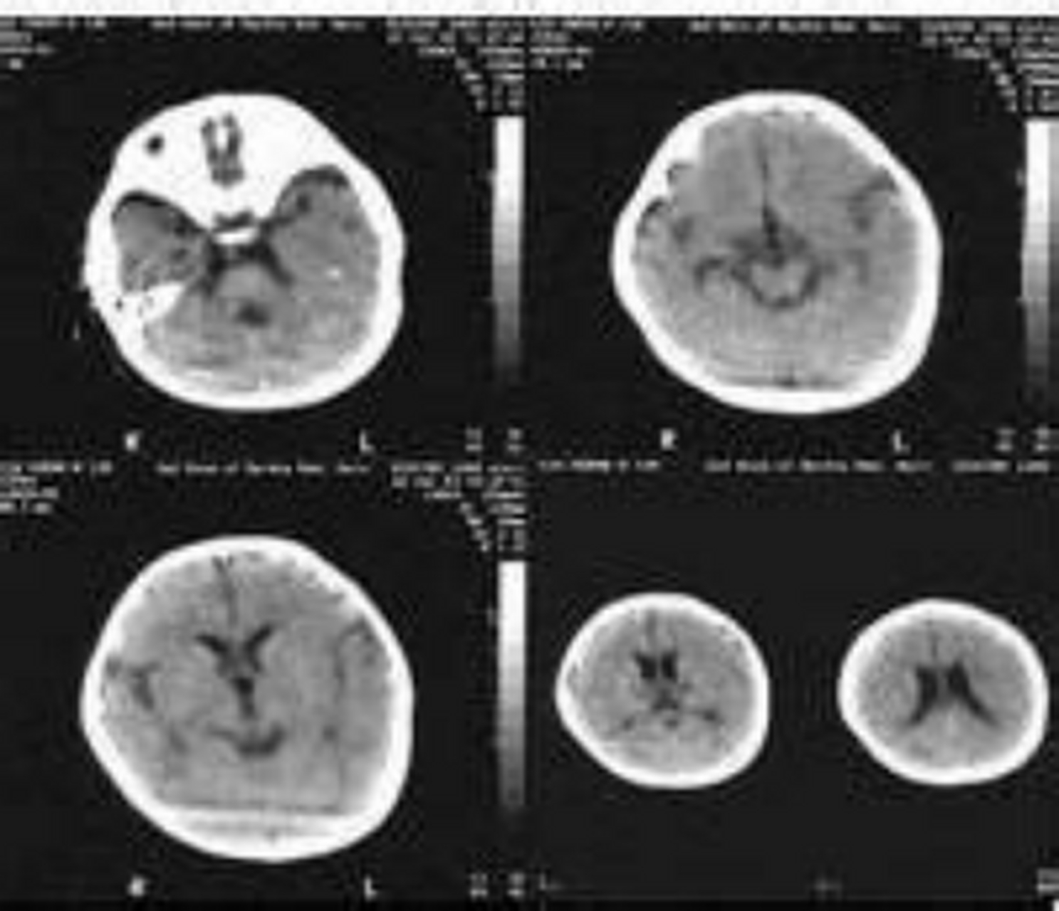 什么是流行性乙型脑炎