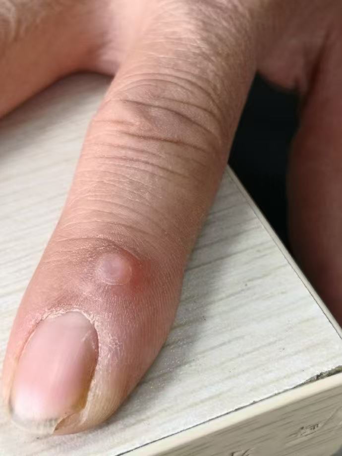 囊肿摸起来是硬的吗?