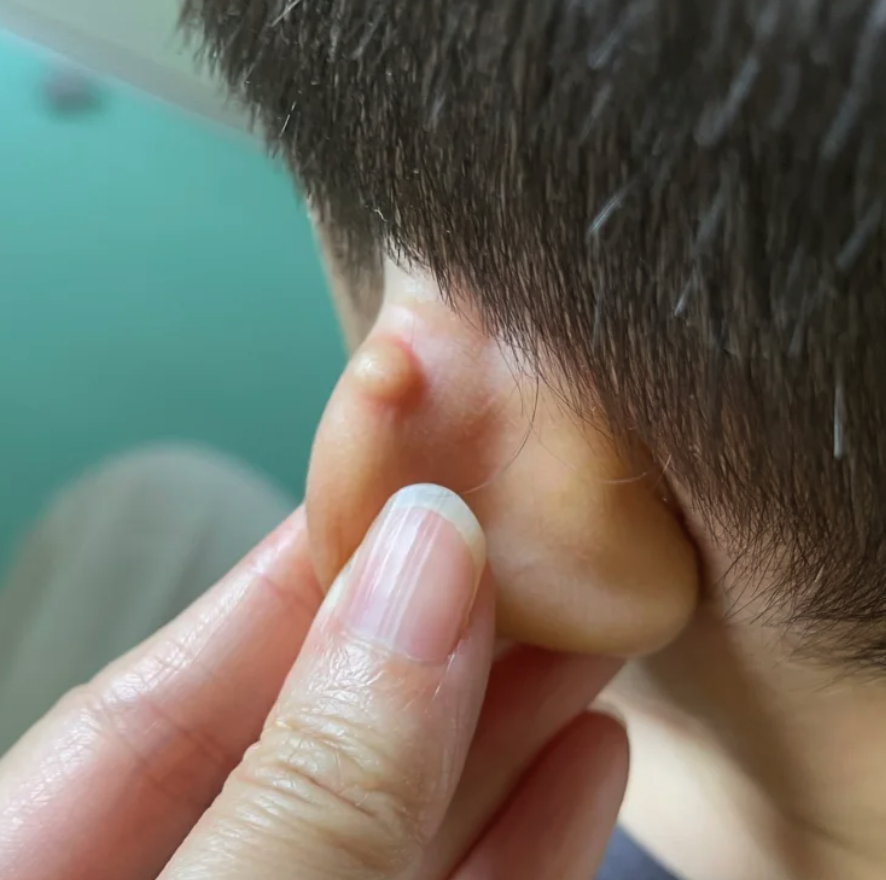 耳朵起个包怎么弄??